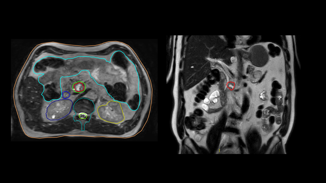 Radiotherapy For Pancreatic Cancer | Products | Elekta