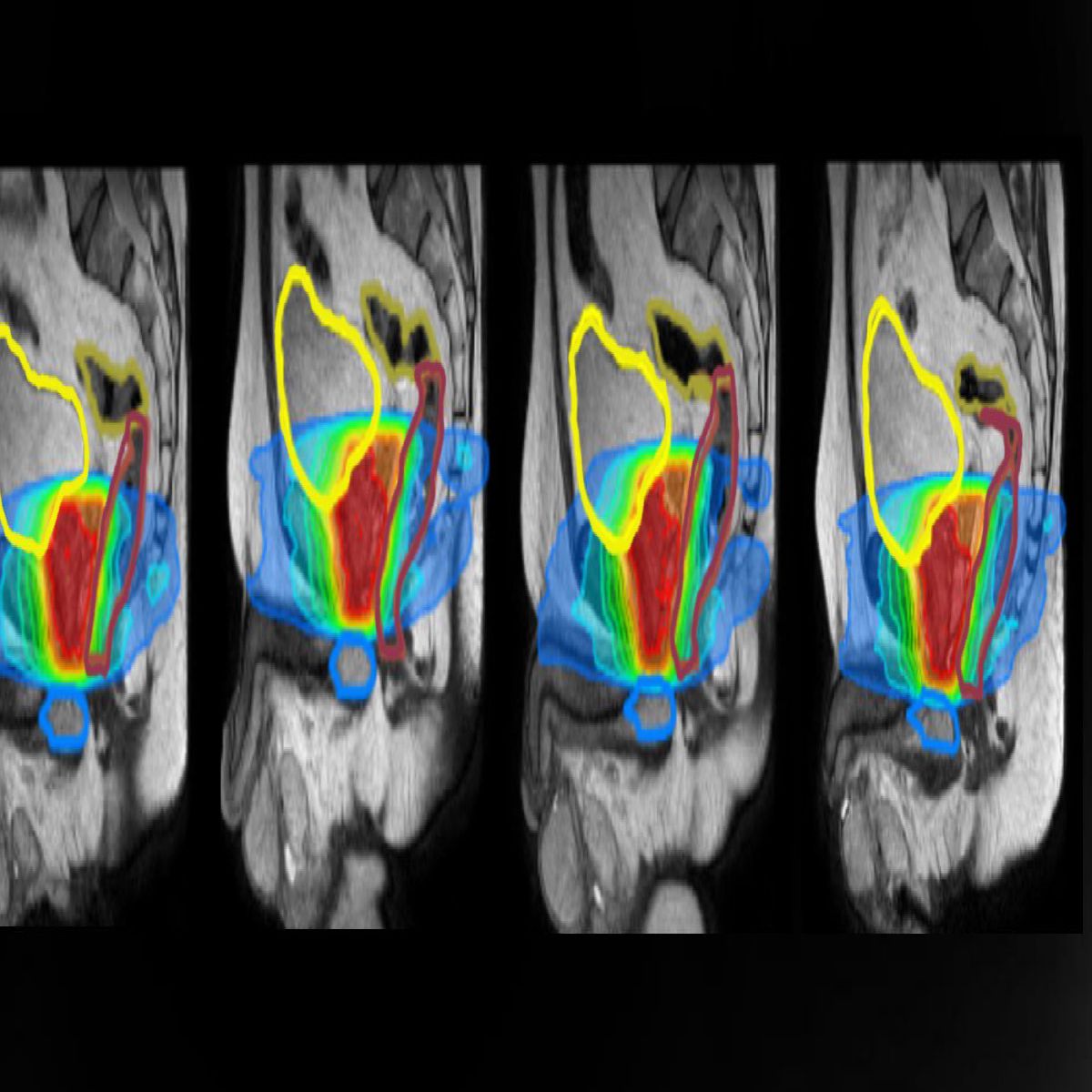 MR Guided Radiation Therapy (MR LINAC) | Patients | Elekta