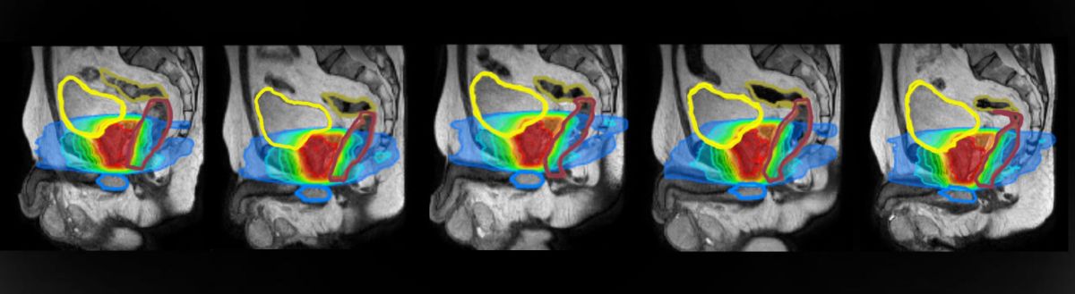 MR-guided RT for prostate cancer | MR-Linac - MR/RT | Radiotherapy | Elekta