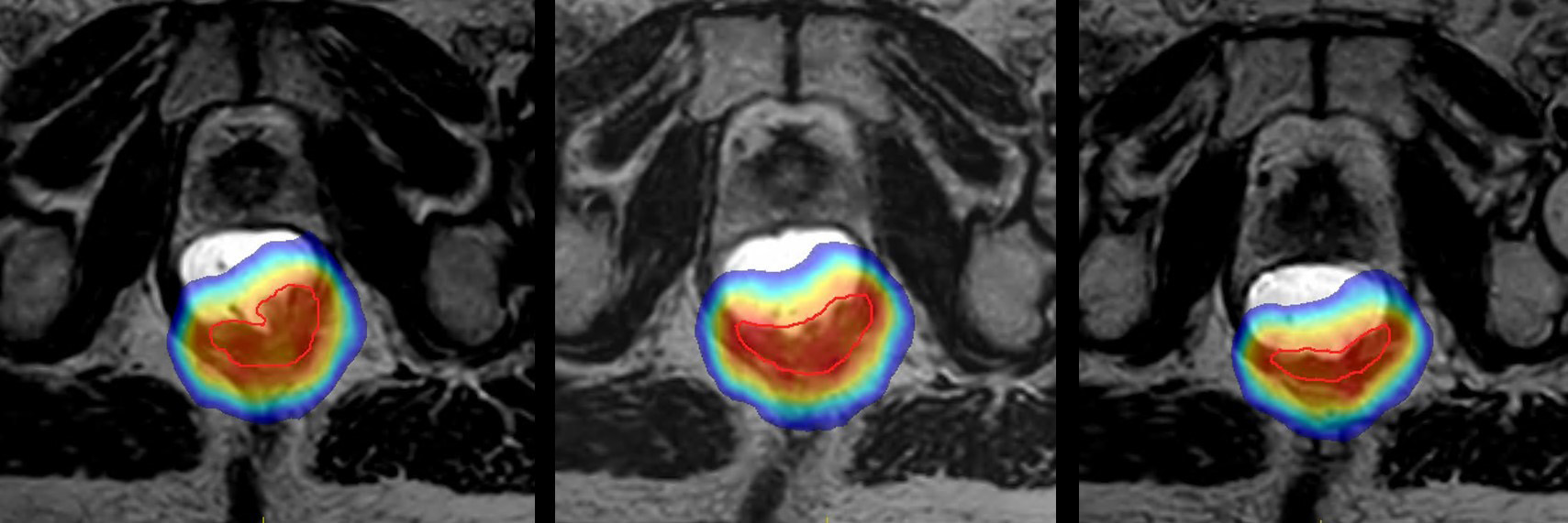 MR-Guided Radiation Therapy for Rectum  | Products | Elekta