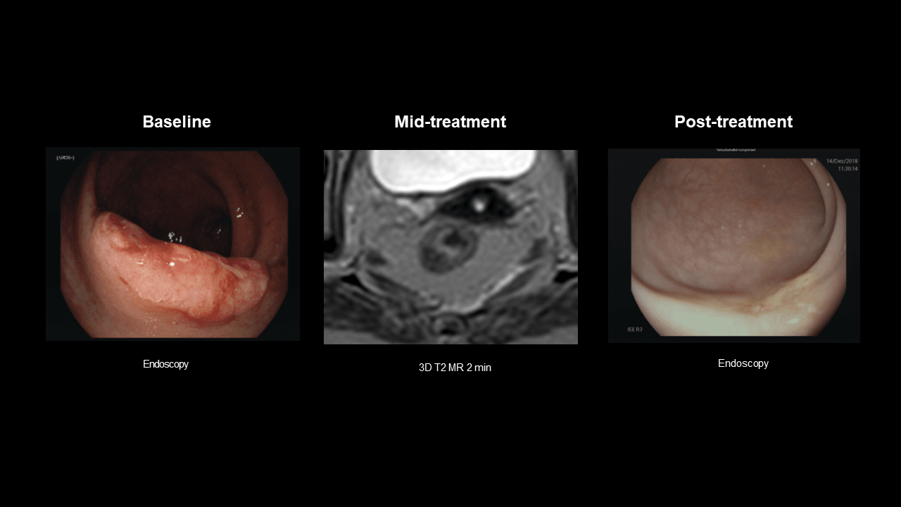 Rectal cancer patient with complete clinical response