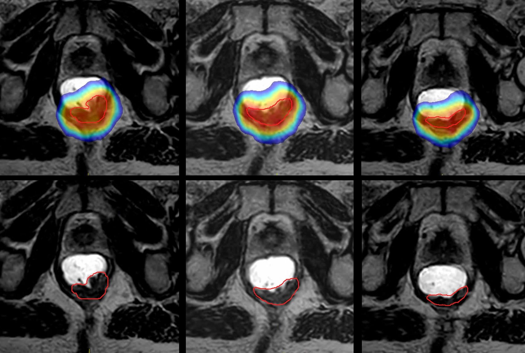 Contouring and dose plan on T2W acquired on Elekta Unity MR-Linac