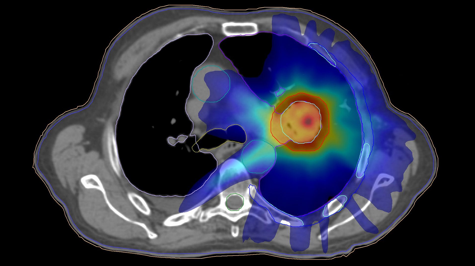 Targeted radiation therapy dose using Elekta Versa HD